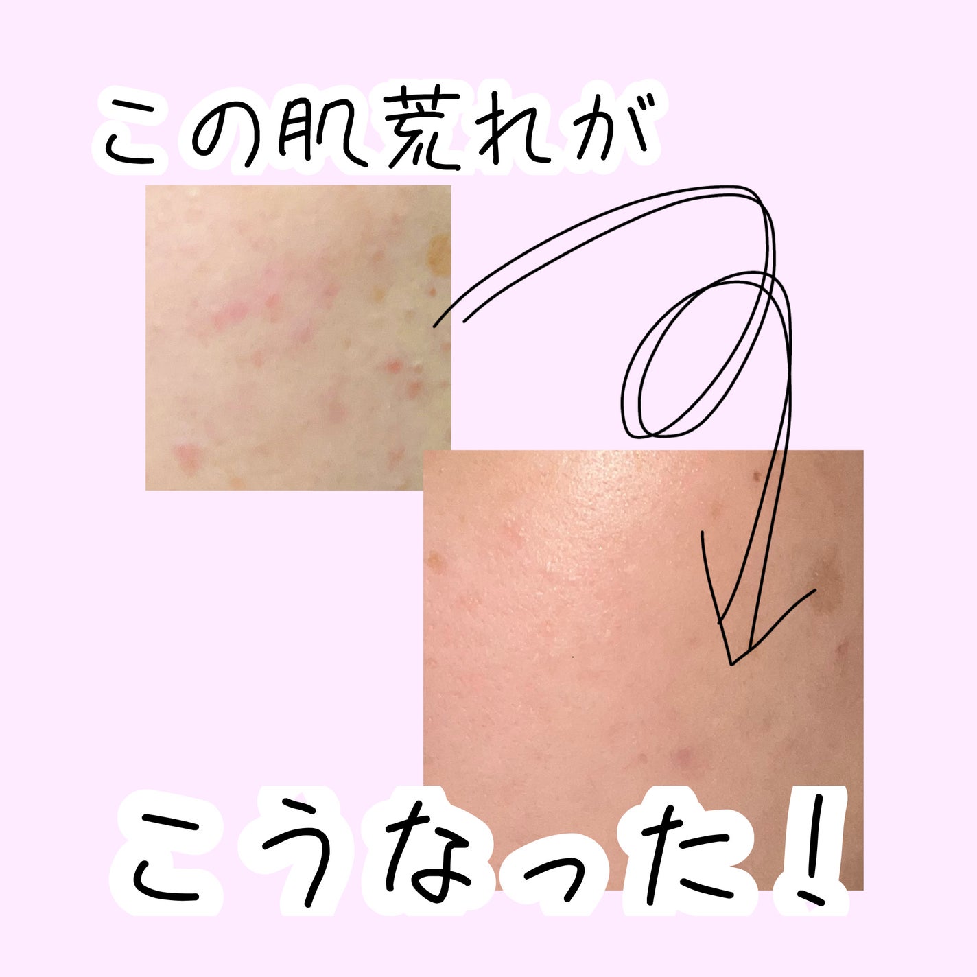 ペアアクネクリームW(医薬品)/ペア/その他を使ったクチコミ(1枚目)