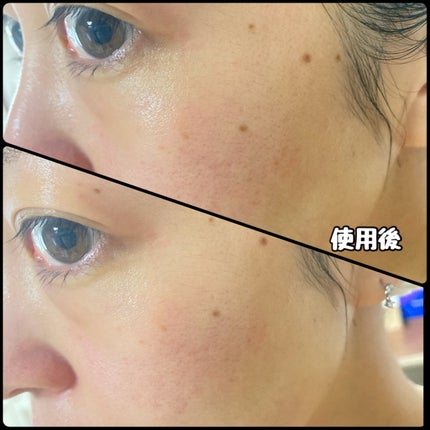 スピテラパーミアPDRNアンプル/NUDIQUE/美容液を使ったクチコミ(4枚目)