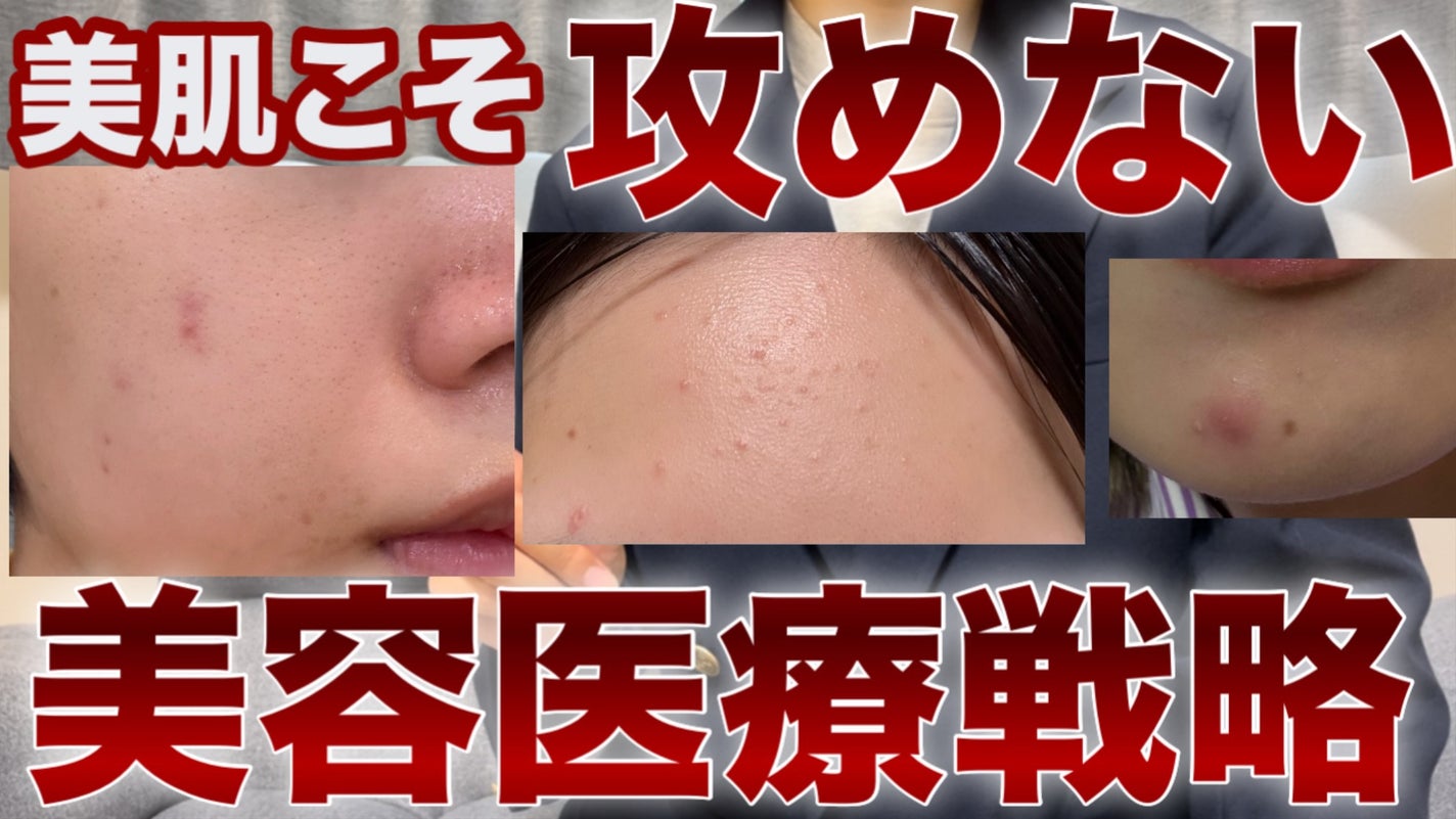 ãã¡ãð°ã¹ãã³ã±ã¢ããã on LIPS ãYouTubeäžãã£ãŠãŸãâïž#çŸå®¹å»ç#çŸå®¹ç®èç§#ã¹ãã³ã±..ãïŒ1æç®ïŒ