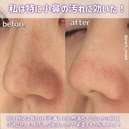 トラブルパッチマスク/EIOM/その他スキンケアを使ったクチコミ(5枚目)