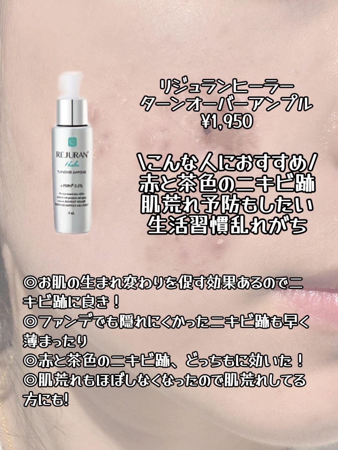 アネトス アクネケア トリートメント セラム/Anetos/美容液を使ったクチコミ（2枚目）