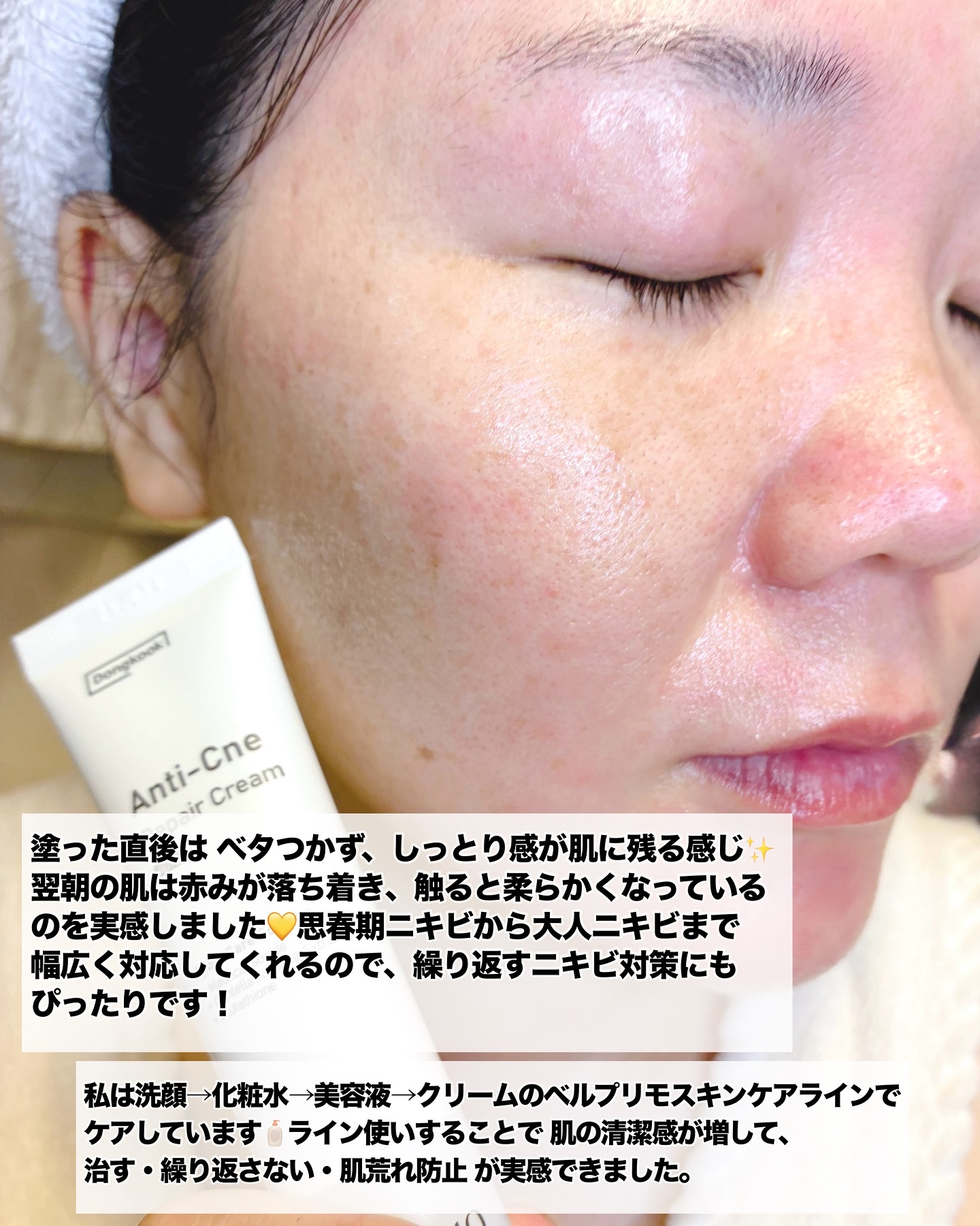 ベルプリモ ACリペアクリーム/BELPRIMO/フェイスクリームを使ったクチコミ（3枚目）