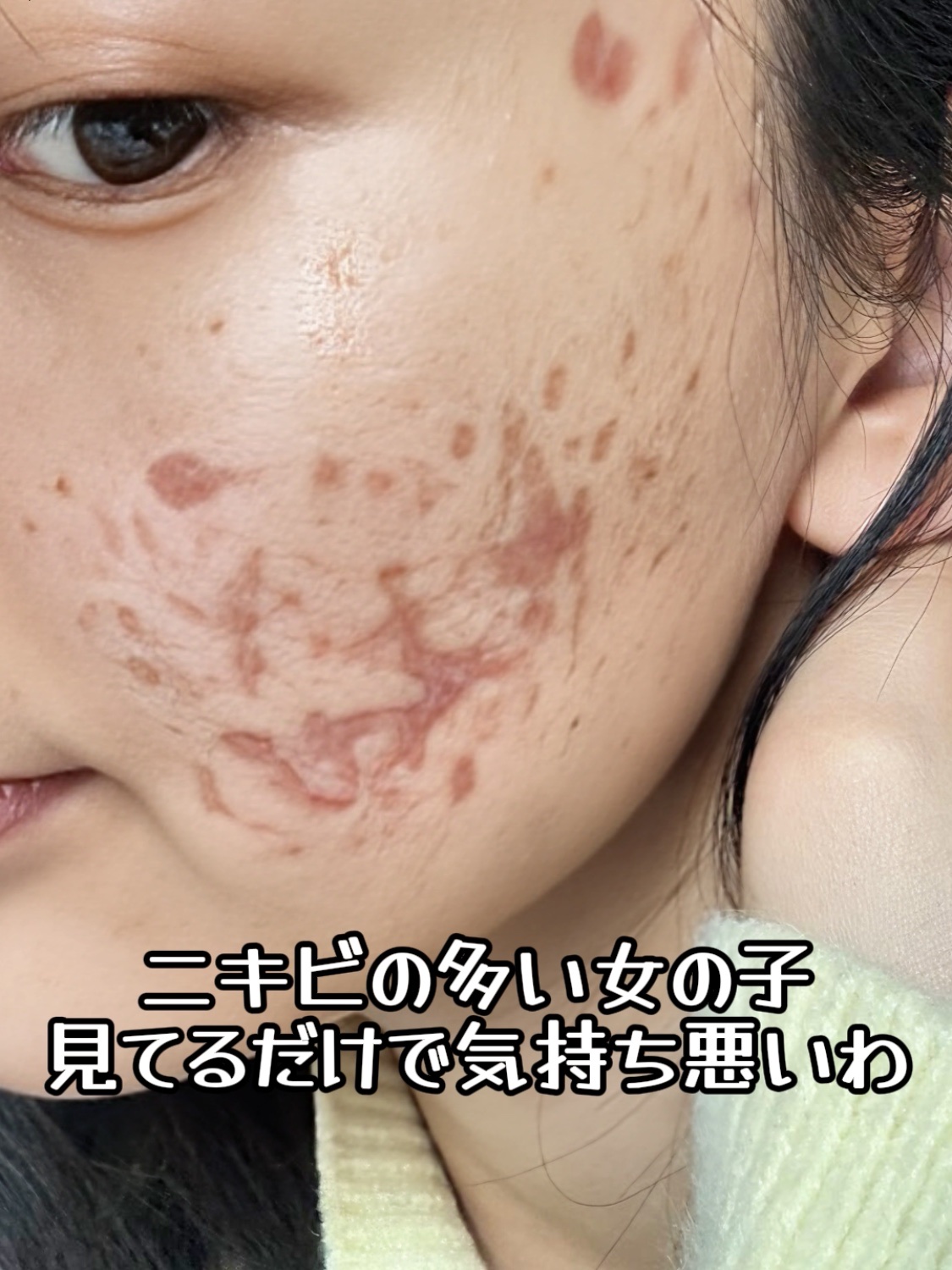 アネトス アクネケア トリートメント セラム/Anetos/美容液を使ったクチコミ（1枚目）