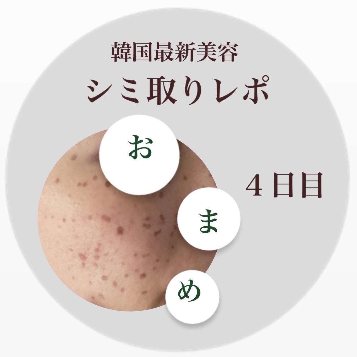 コスメとは関係ありませんが🙇🏻‍♀️

シミ取り経過レポ💫４日目💫

茶色が濃いくなってきて
カサブタっぽくなってきました！
もう少しで取れそうな気もしますが
我慢〜〜😣笑

ビタミン系のサプリで中からシミ対策します✨

#あった