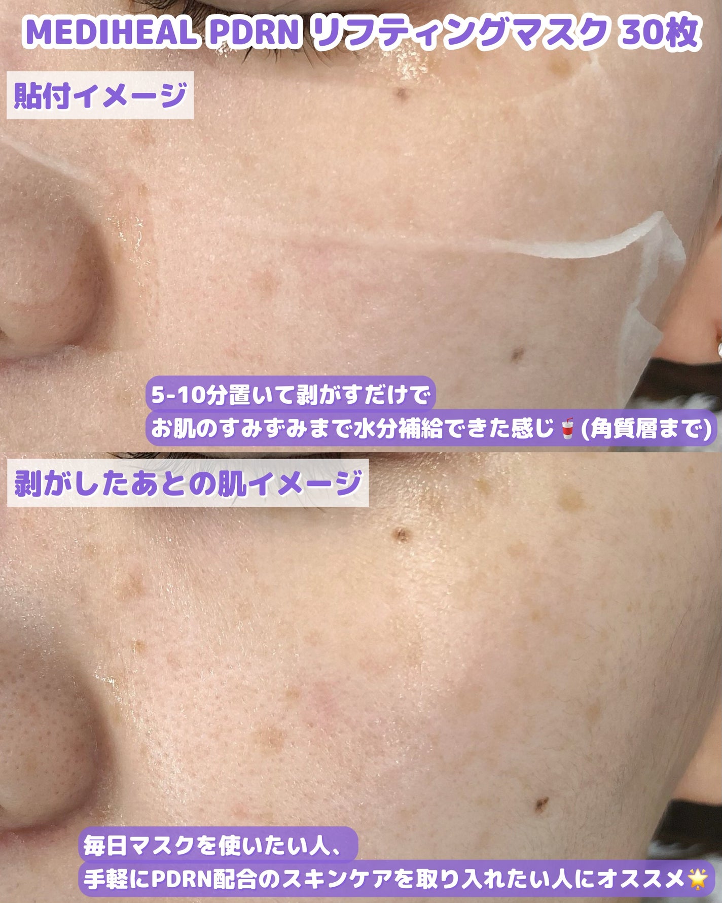 PDRN リフティングマスク/MEDIHEAL/シートマスク・パックを使ったクチコミ(4枚目)