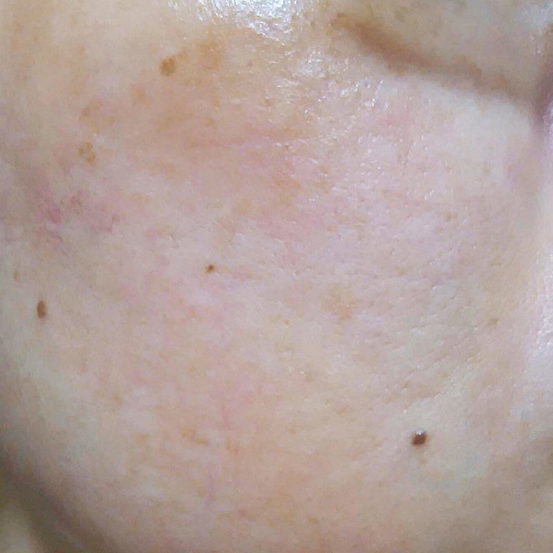 PDRN+リードルS 100/VT/美容液を使ったクチコミ（3枚目）