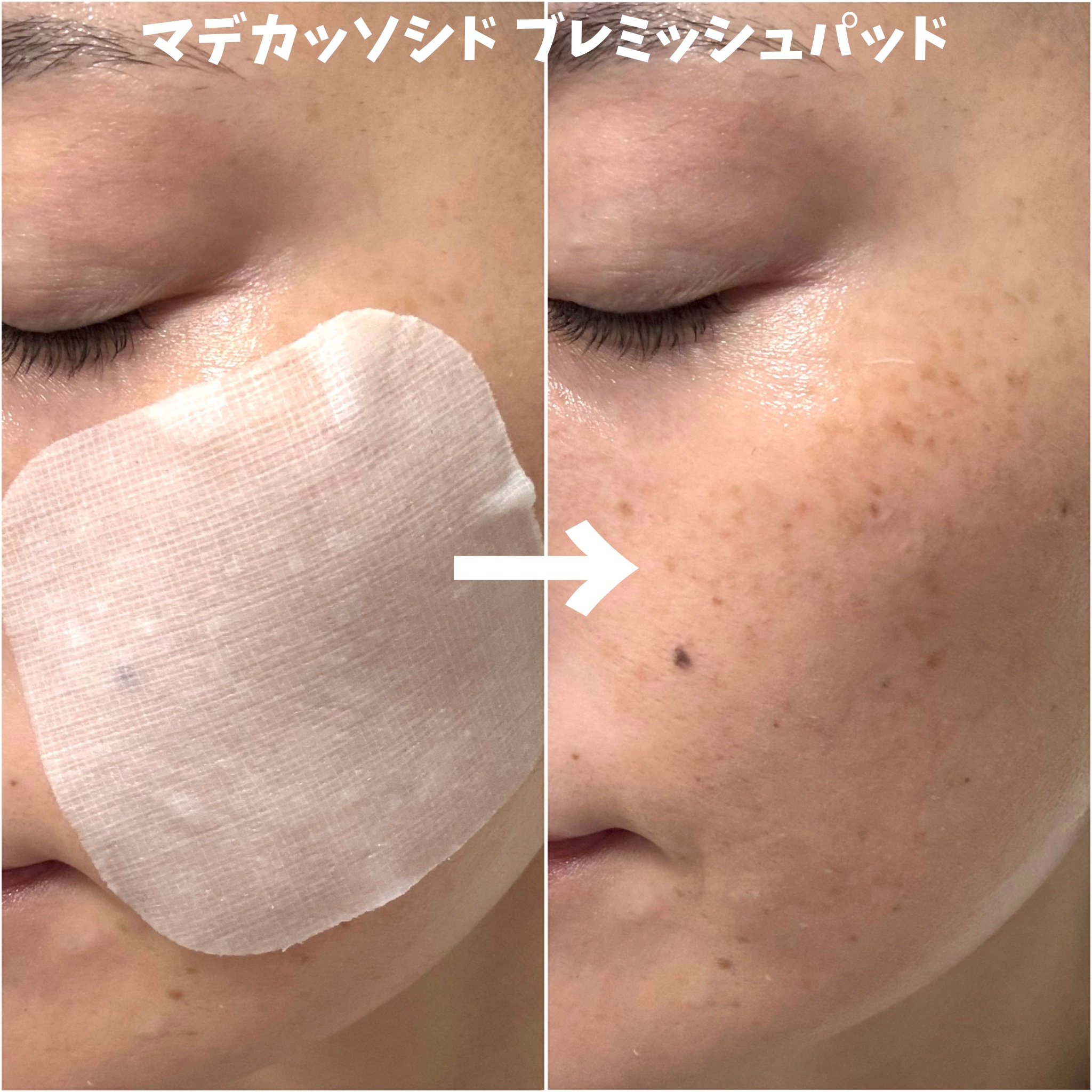 PDRN リフティングマスク/MEDIHEAL/シートマスク・パックを使ったクチコミ（3枚目）