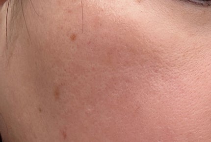 Rie Nakamura on LIPS 「昨日シミケアしに行ったんです。1枚目は当日のシミ2枚目は1日後..」(2枚目)