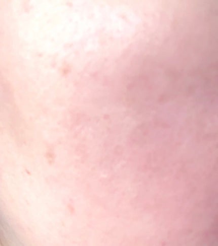 Rie Nakamura on LIPS 「昨日シミケアしに行ったんです。1枚目は当日のシミ2枚目は1日後..」(1枚目)