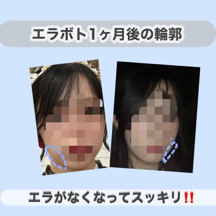 つむぎ on LIPS 「エラボトを打ってきたのレポートします‼️エラボトを打った理由は..」(4枚目)