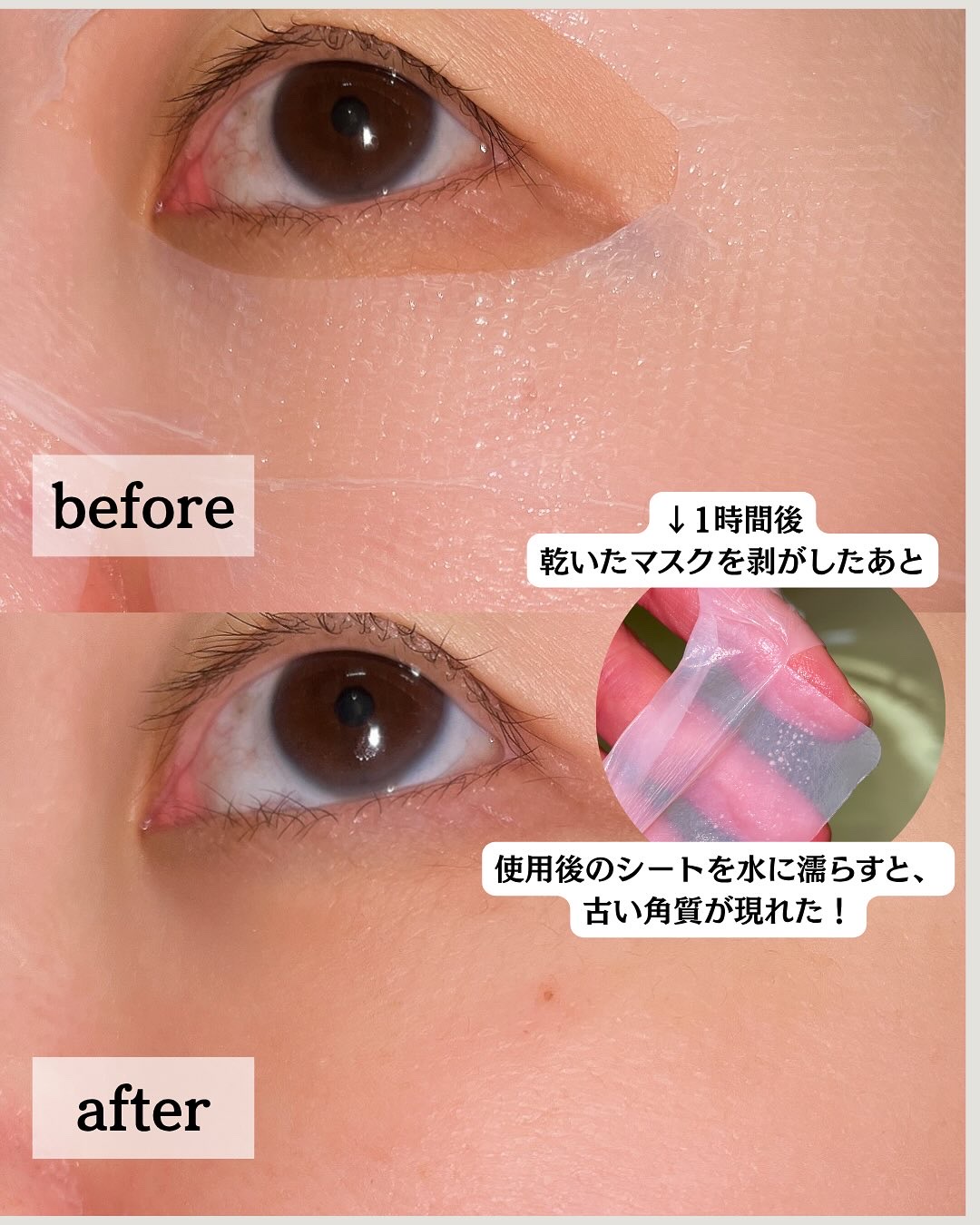 トラブルパッチマスク/EIOM/その他スキンケアを使ったクチコミ（3枚目）