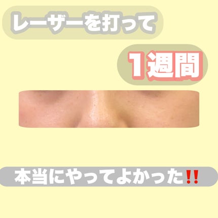 つむぎ on LIPS 「シミ取りをするか悩んでる人は是非見てください‼️シミ取りをした..」(5枚目)