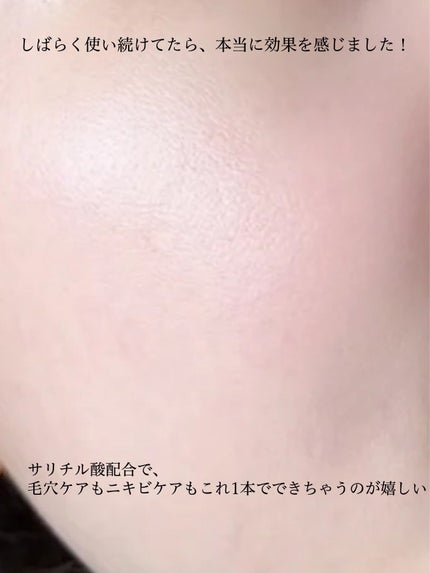 アネトス アクネケア トリートメント セラム/Anetos/美容液を使ったクチコミ(8枚目)