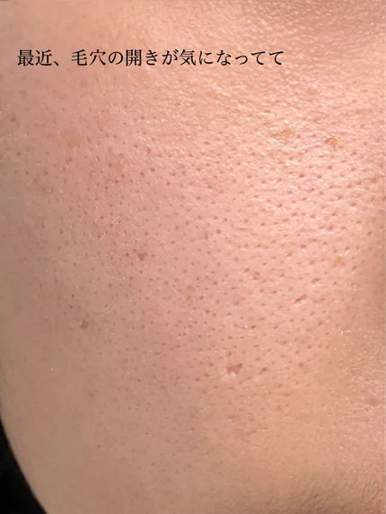 アネトス アクネケア トリートメント セラム/Anetos/美容液を使ったクチコミ(5枚目)