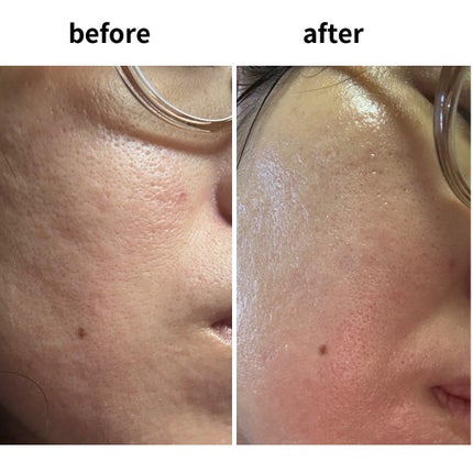 リードルS PDRN+ セラム/VT/美容液を使ったクチコミ(5枚目)