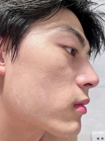 アネトス アクネケア トリートメント セラム/Anetos/美容液を使ったクチコミ(3枚目)