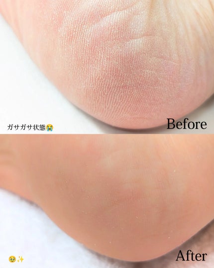 ありちゃん@フォロバ100🤍 on LIPS 「\硬い角質、即やわらか💜/Baren様から提供いただきました✨..」(4枚目)