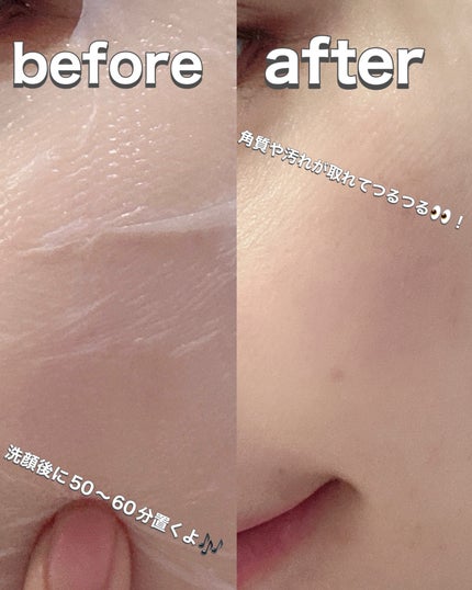 トラブルパッチマスク/EIOM/その他スキンケアを使ったクチコミ(3枚目)