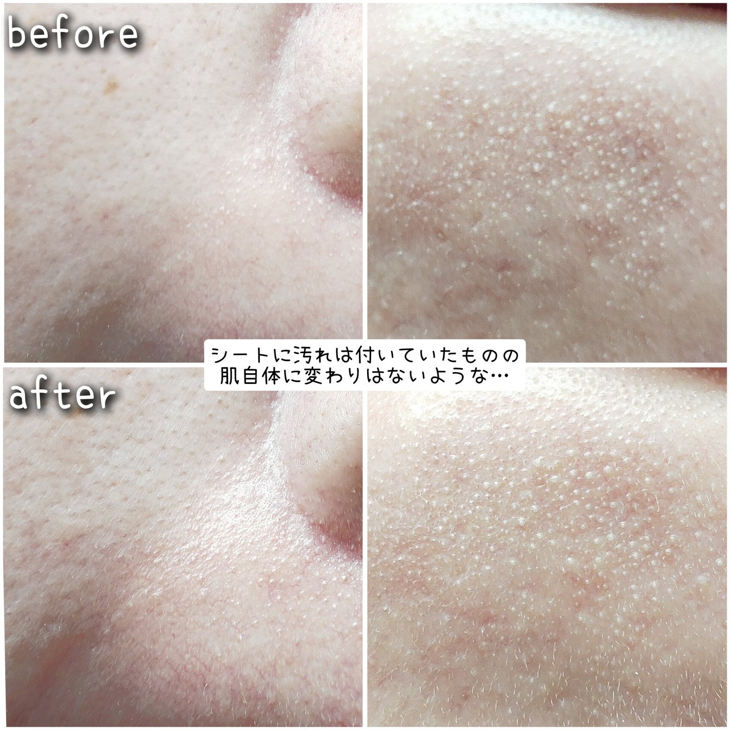 トラブルパッチマスク/EIOM/その他スキンケアを使ったクチコミ(4枚目)