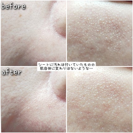 トラブルパッチマスク/EIOM/その他スキンケアを使ったクチコミ(4枚目)