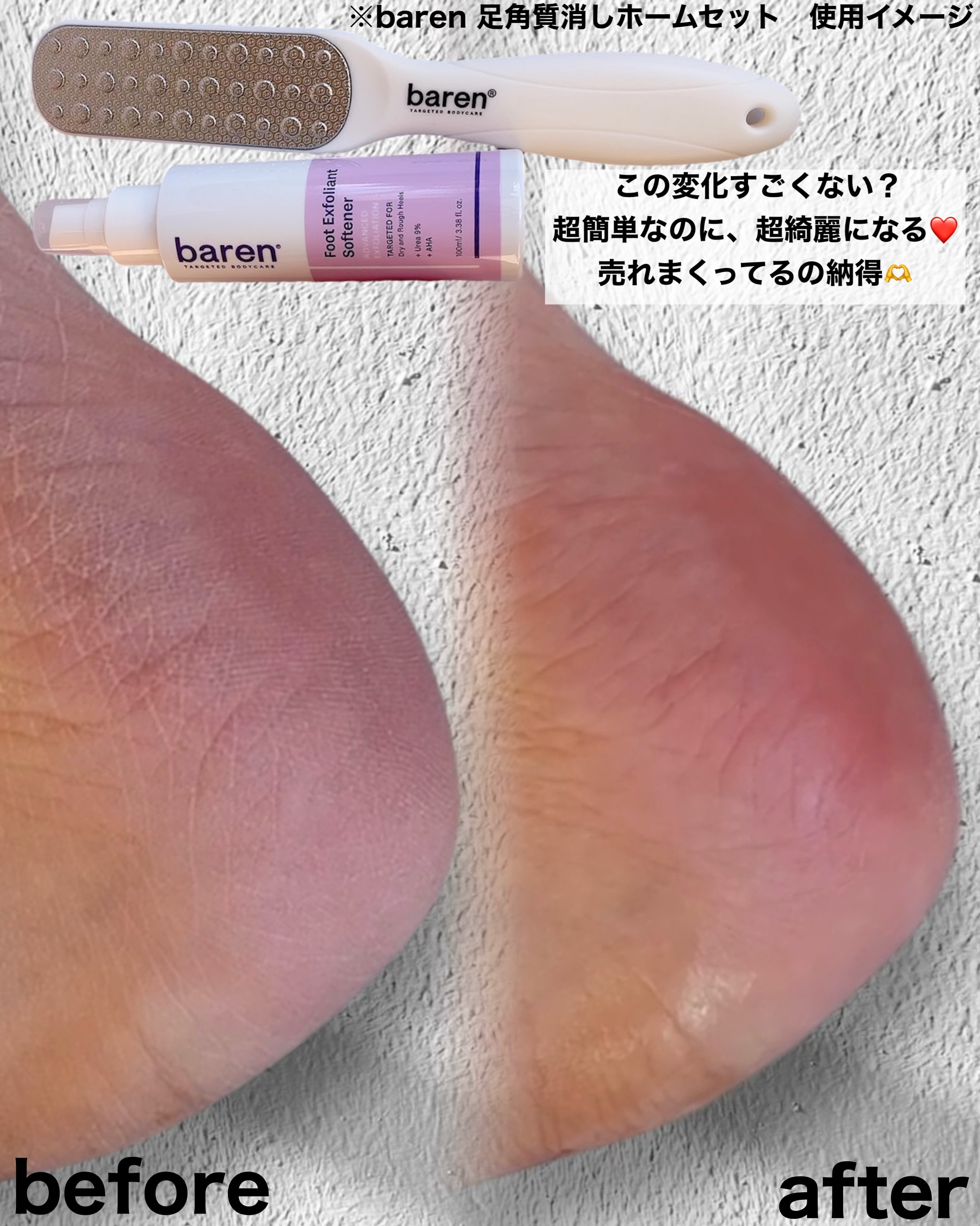 フットケアセット/BAREN/その他キットセットを使ったクチコミ（3枚目）