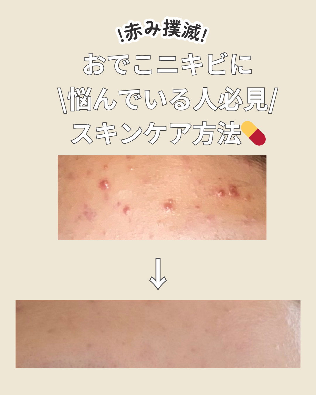 マンデリック インテンシブ 18%セラム/DR.WU/美容液を使ったクチコミ（1枚目）