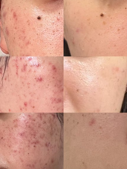 アゼライン酸15 インテンスカーミングセラム/Anua/美容液を使ったクチコミ(2枚目)