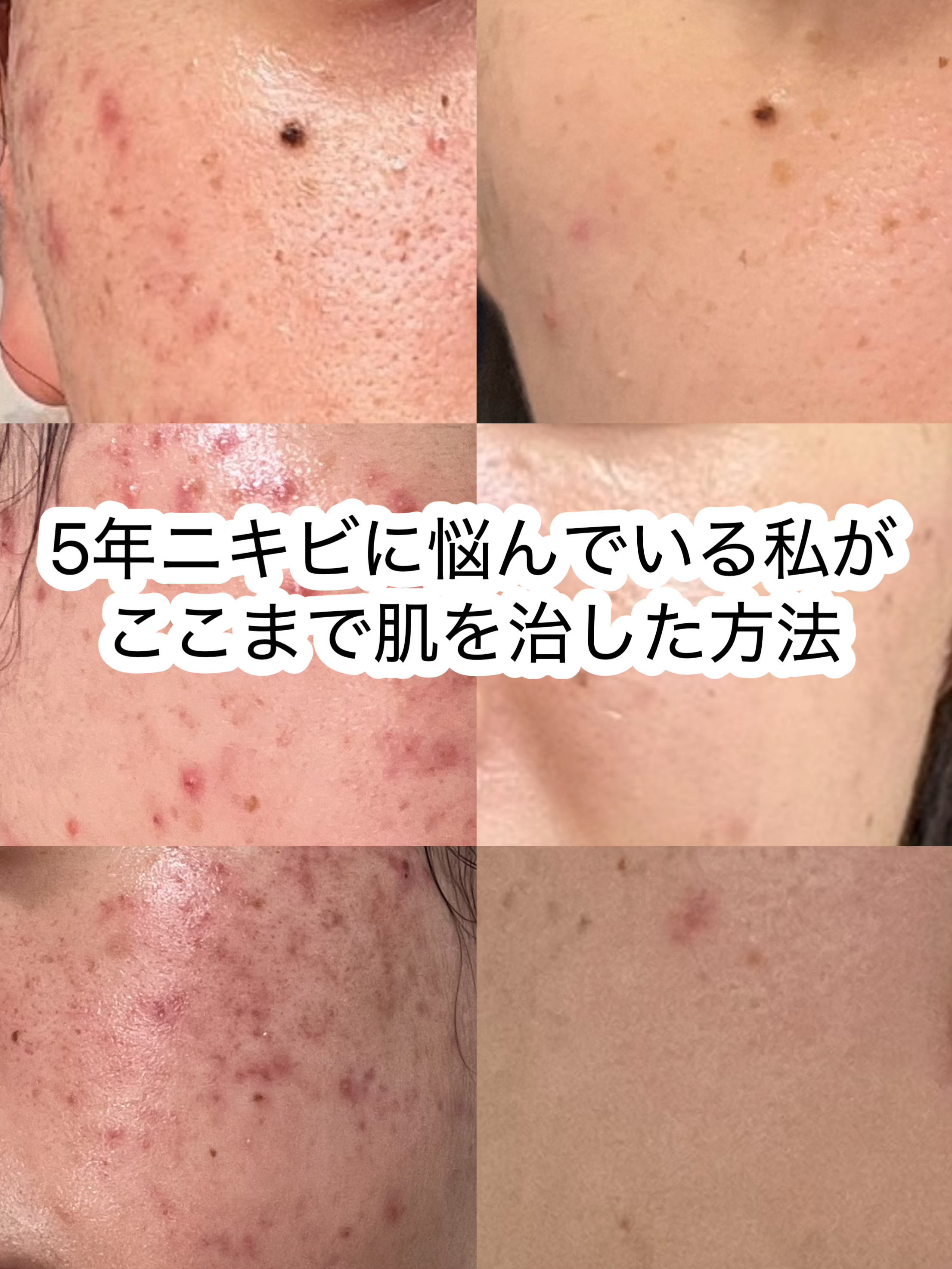 アゼライン酸15 インテンスカーミングセラム/Anua/美容液を使ったクチコミ（1枚目）