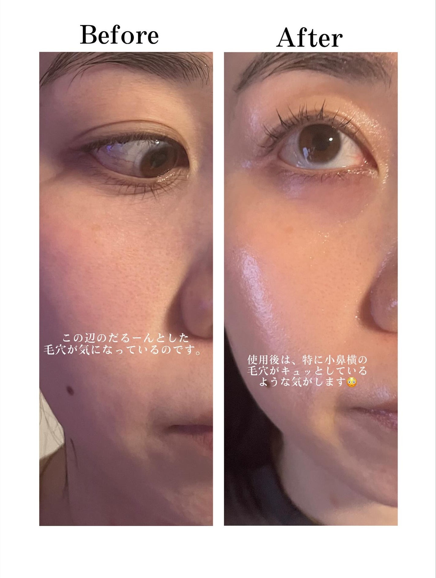 トラブルパッチマスク/EIOM/その他スキンケアを使ったクチコミ(3枚目)