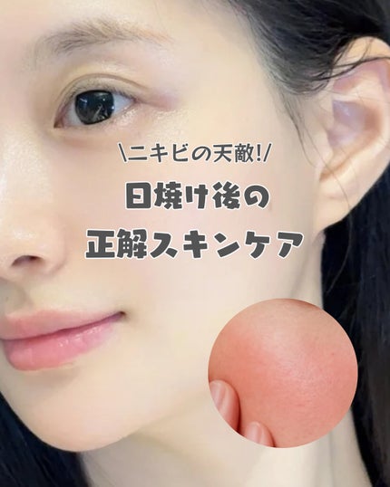 アネトス アクネケア トリートメント セラム/Anetos/美容液を使ったクチコミ(1枚目)