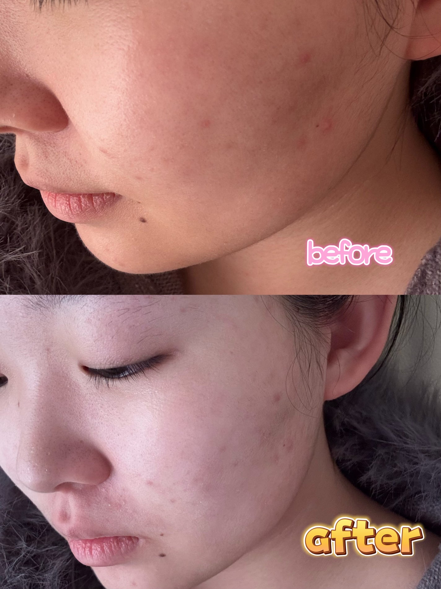 トラブルパッチマスク/EIOM/その他スキンケアを使ったクチコミ(2枚目)