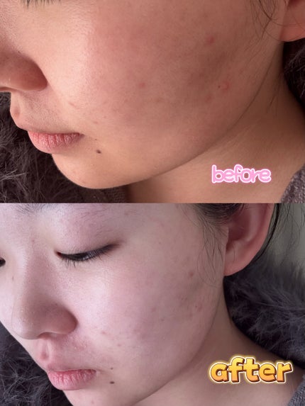 トラブルパッチマスク/EIOM/その他スキンケアを使ったクチコミ(2枚目)