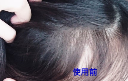 アデノバイタル スカルプ パワーショット/サブリミック/頭皮ローションを使ったクチコミ(5枚目)