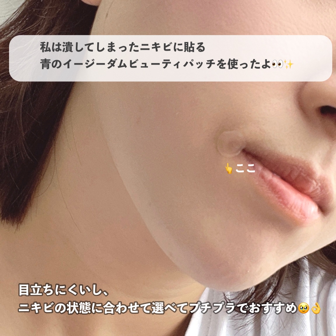 ビューティー スポットパッチ/イージーダムビューティー/にきびパッチを使ったクチコミ（2枚目）