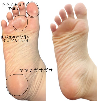 ゴウンバル クリーム/3WB/レッグ・フットケアを使ったクチコミ(2枚目)