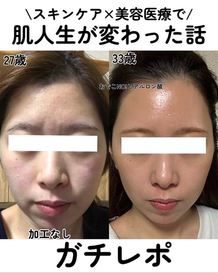 kotori_フォロバ100! on LIPS 「💖スキンケア×美容医療で肌人生が変わった話💖【ガチレポ】で、な..」(1枚目)