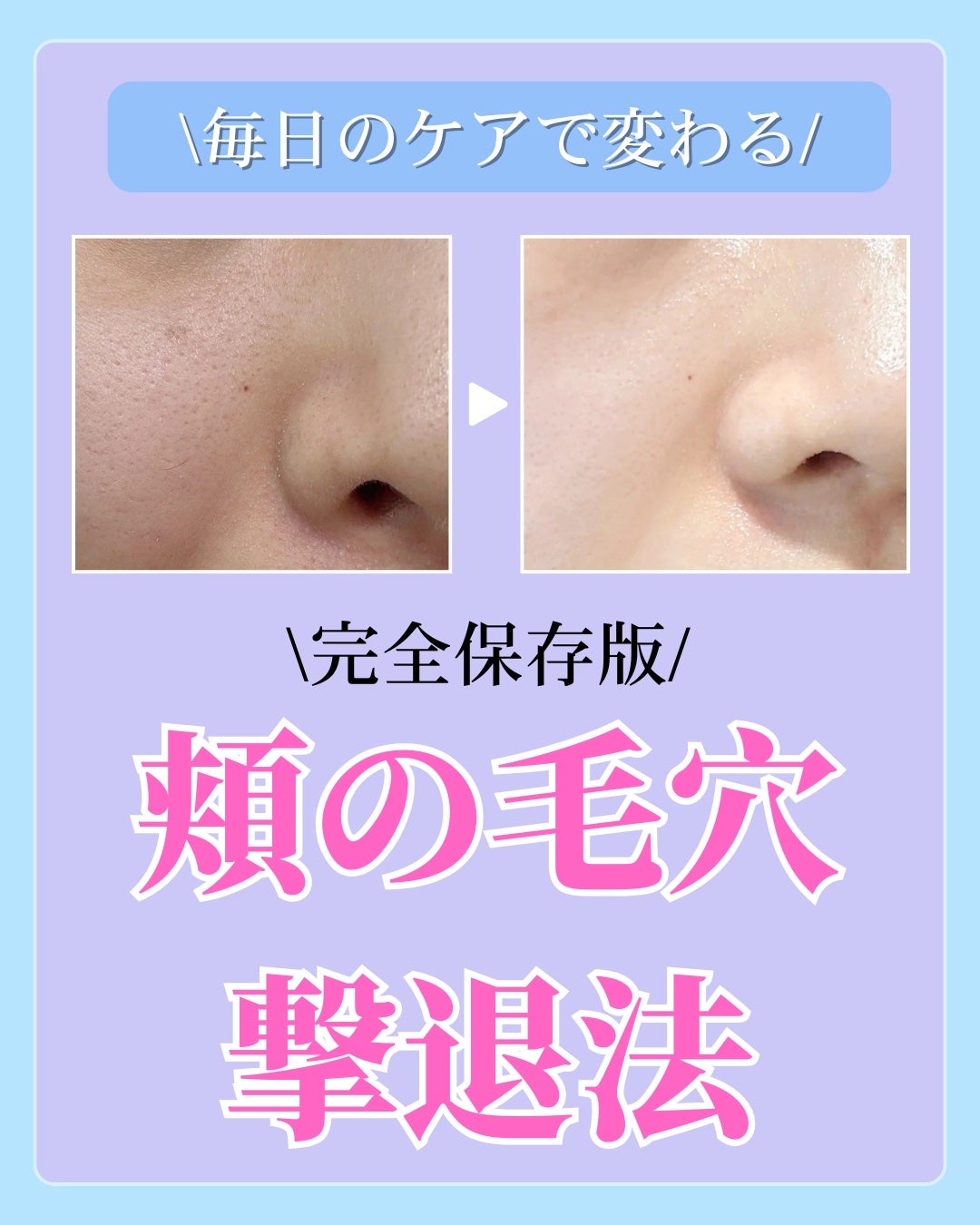 肌レポ編集室 on LIPS 「毎日のケアで変わる/頬の毛穴撃退法正直、毛穴はなかなか消えない..」(1枚目)