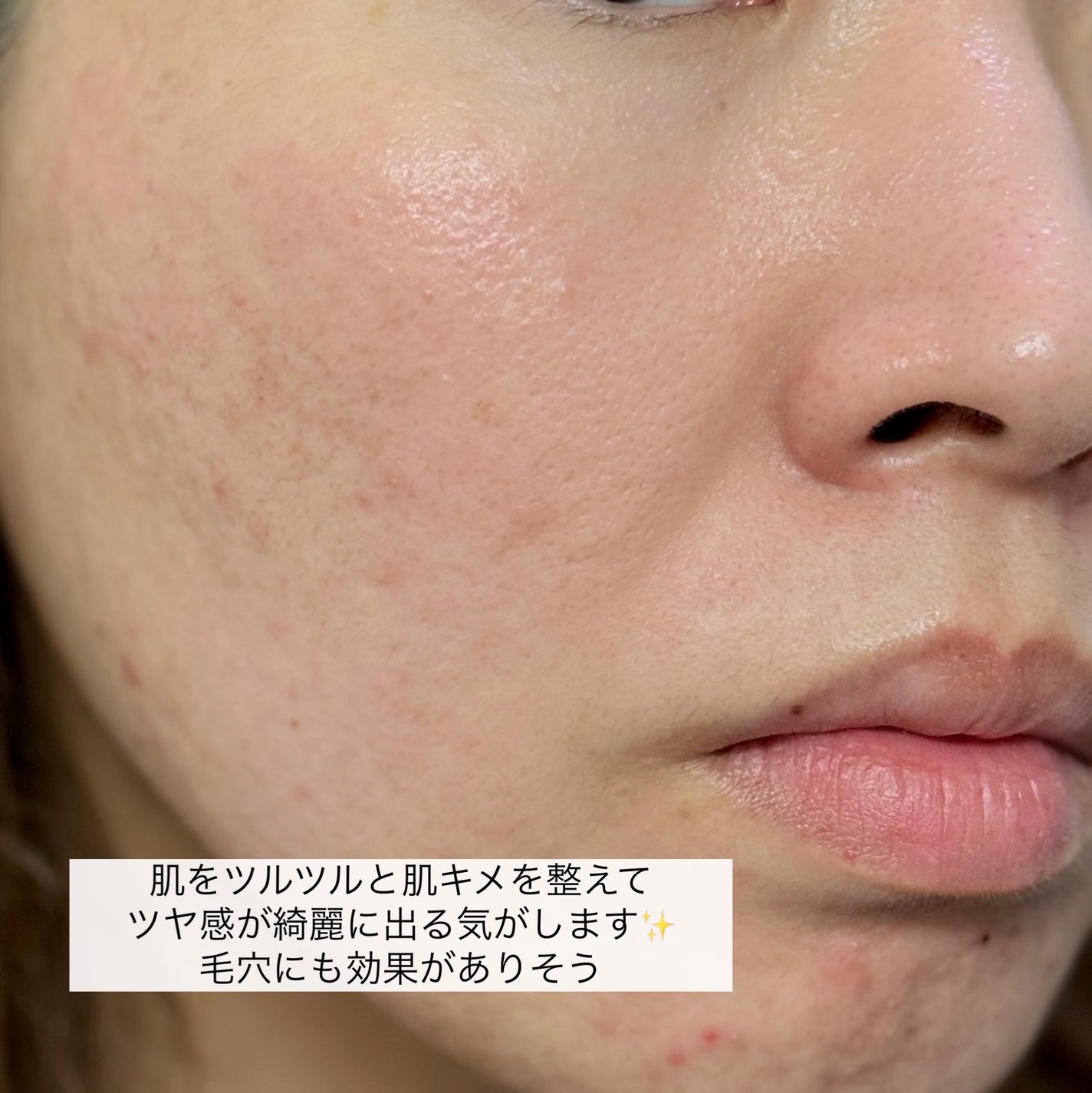 RXã¶ã»ãã¿ãã³C23ã»ã©ã /COSRX/çŸå®¹æ¶²ã䜿ã£ãã¯ãã³ãïŒ9æç®ïŒ