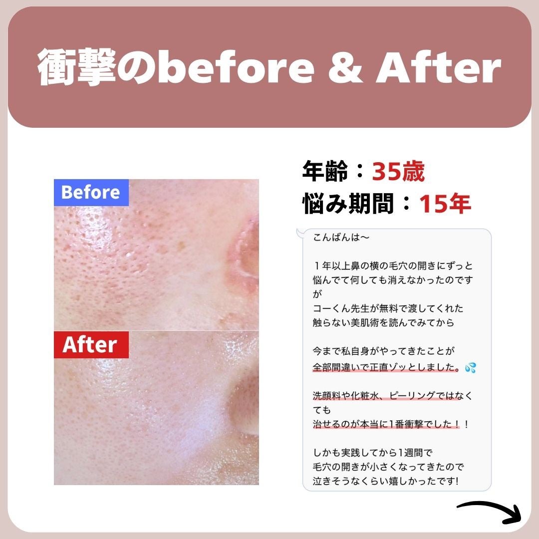 あなたの肌に合ったスキンケア💐コーくん先生 on LIPS 「【コレ見るだけ】毛穴の開き死ぬほど消える神スキンケア🤫..あな..」(4枚目)