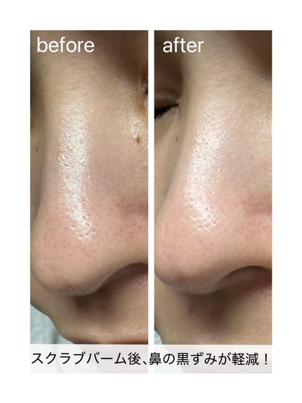 ブラックヘッドバームスクラブ/オブジェ/フェイスバームを使ったクチコミ(6枚目)
