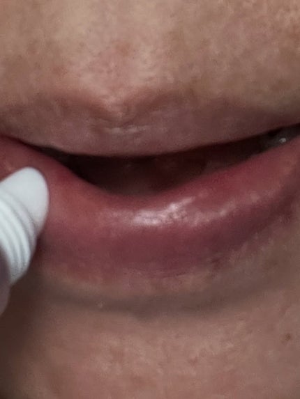 ナイトニードルリップ ディープモイスト/CHOOSY/リップ美容液を使ったクチコミ(3枚目)