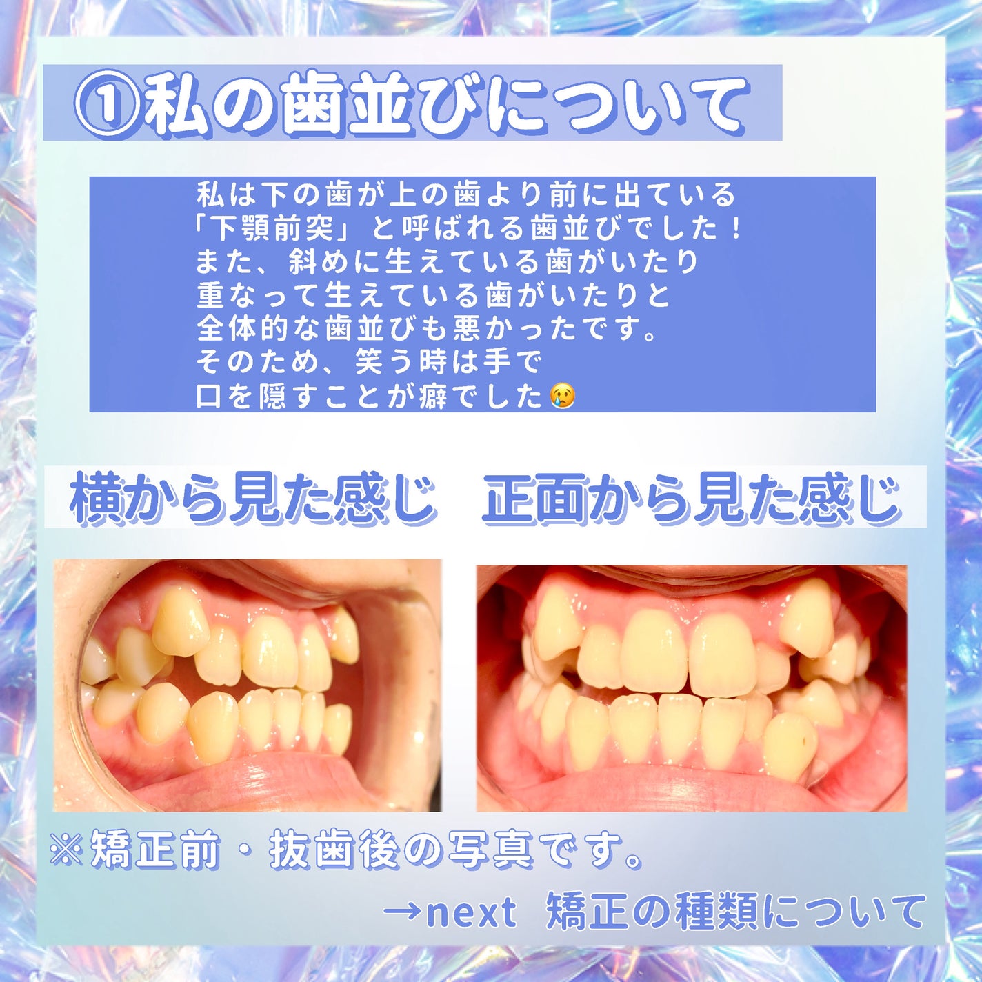 macaron@フォロバ100 on LIPS 「【完全保存版!私の歯列矯正記録🦷】今回は2年半行った私の歯列矯..」(2枚目)