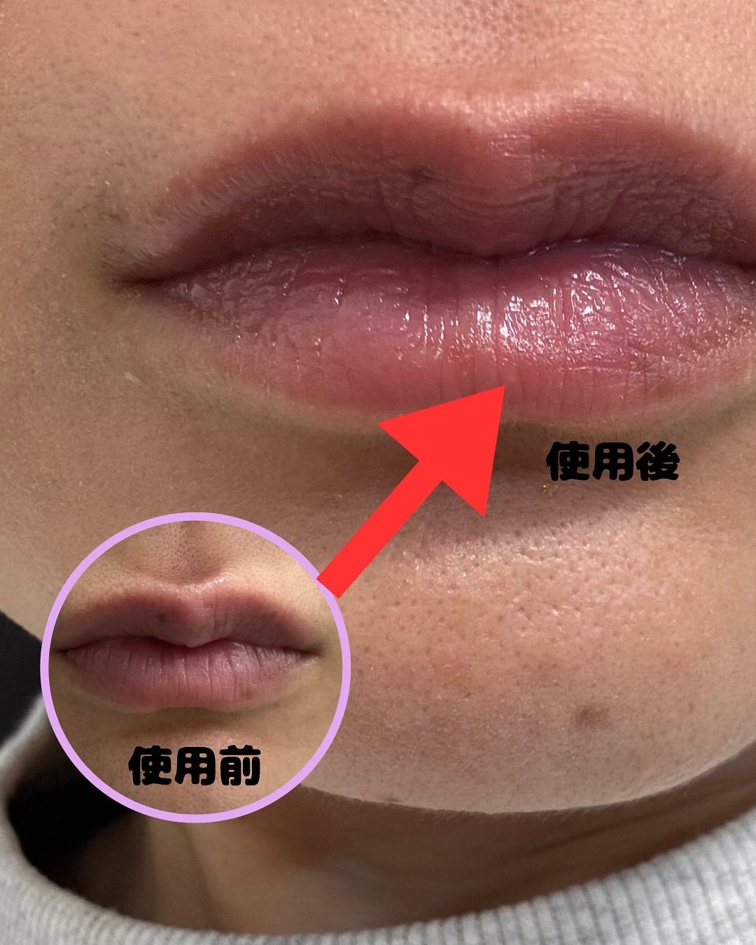 ナイトニードルリップ ディープモイスト/CHOOSY/リップ美容液を使ったクチコミ(4枚目)