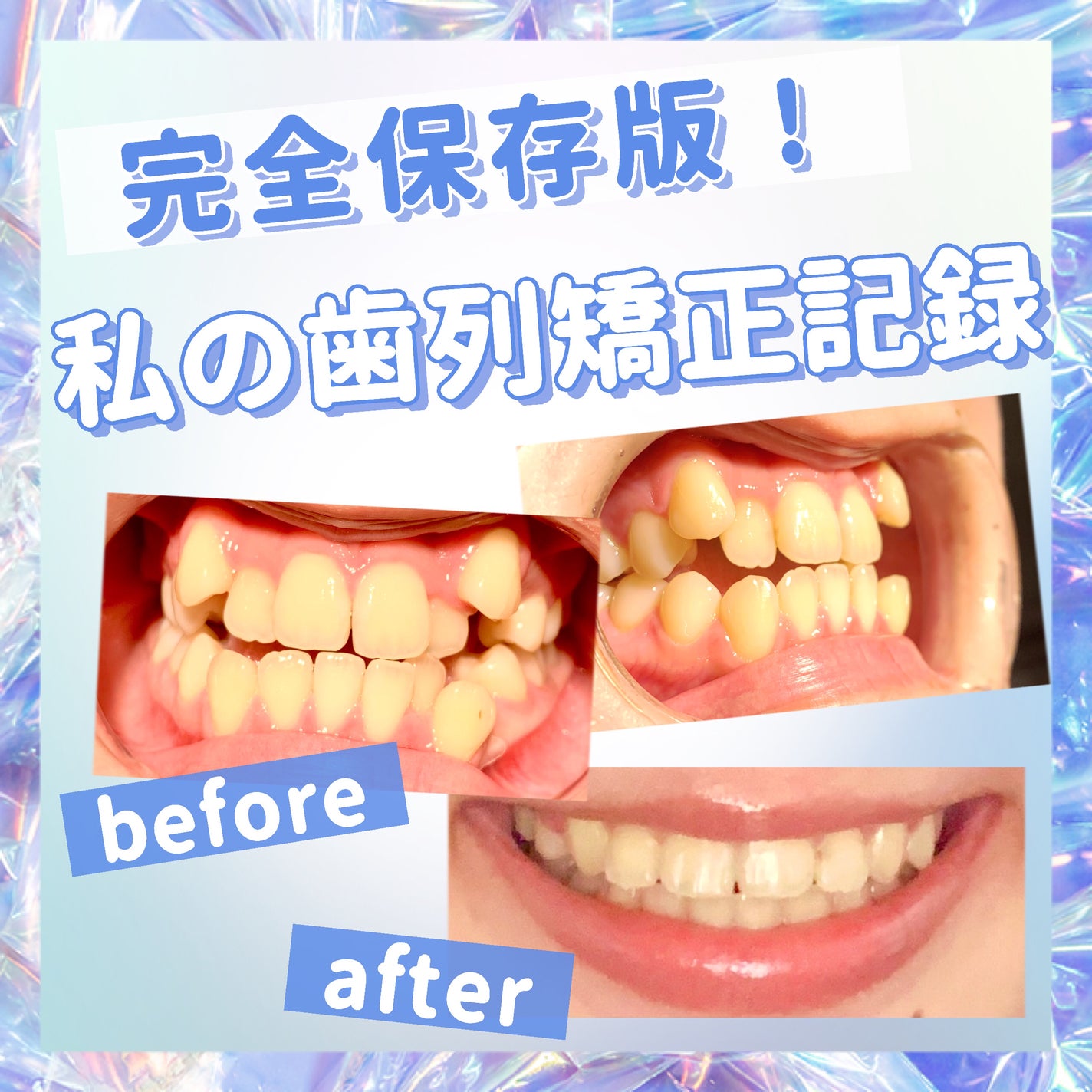 macaron@フォロバ100 on LIPS 「【完全保存版!私の歯列矯正記録🦷】今回は2年半行った私の歯列矯..」(1枚目)