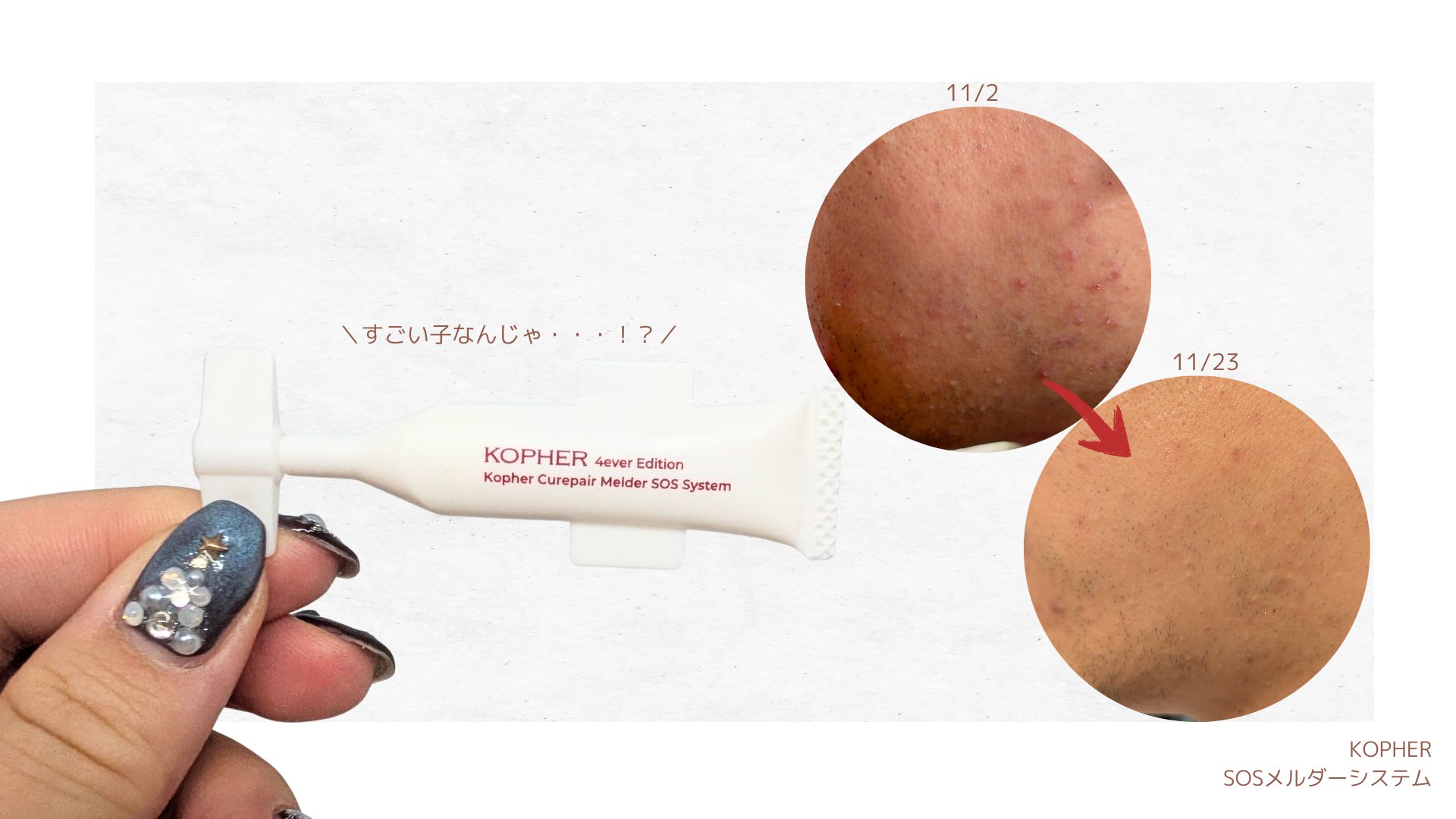 SOSメルダーシステム/KOPHER/フェイスクリームを使ったクチコミ（3枚目）