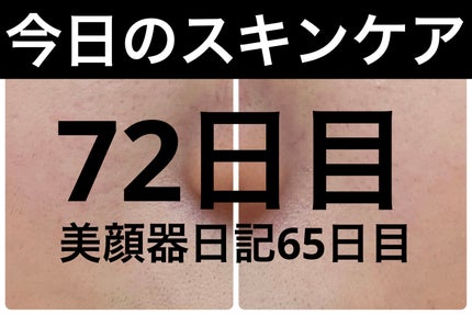 PDRN ヒアルロン酸 ミントマイクロバブルセラム/VT/美容液を使ったクチコミ(1枚目)