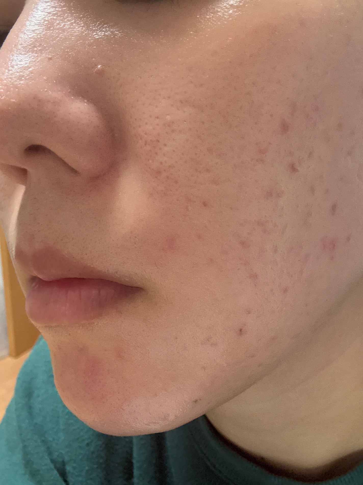 twinkle_blush_pbr on LIPS 「2025/11/26アダパレン、ベピオゲル継続してるけど生理が..」(3枚目)