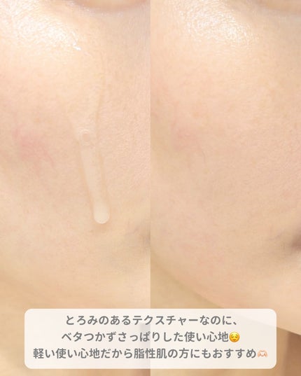 トラブルパッチマスク/EIOM/その他スキンケアを使ったクチコミ(5枚目)