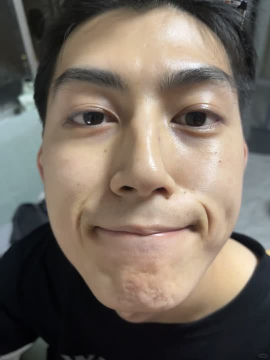 アネトス アクネケア トリートメント セラム/Anetos/美容液を使ったクチコミ（3枚目）