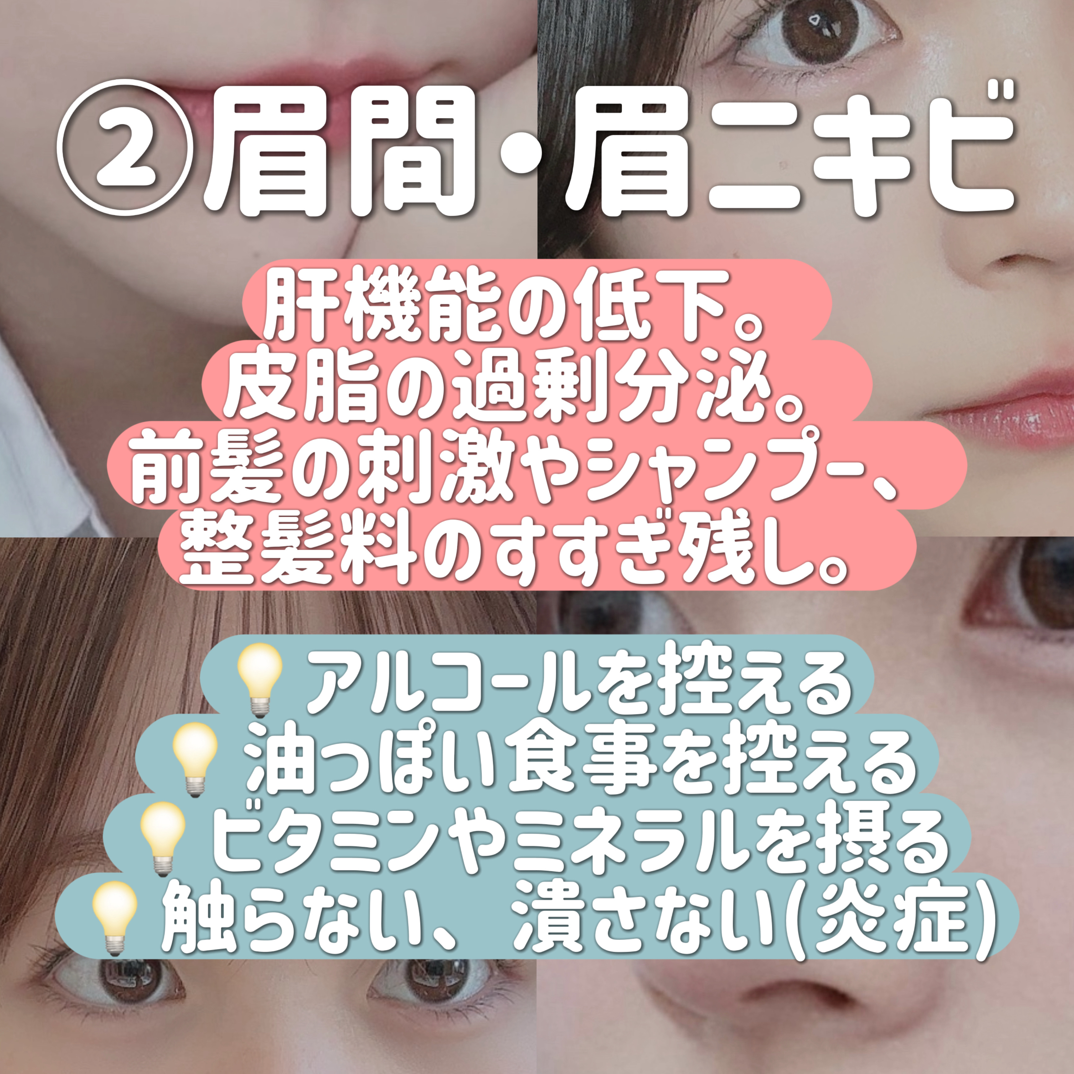 ラ ロッシュ ポゼ エファクラ ピールケア セラムのクチコミ「＼そのニキビの原因は？／

場所別原因と改善法まとめ❤︎

……………………………………

肌.....」（3枚目）